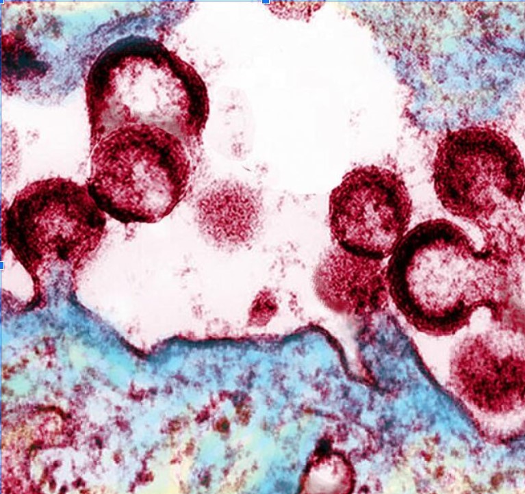 Pesquisas iniciais sugerem que medicamento contra o câncer pode ajudar a expulsar o HIV de seus esconderijos lazy placeholder